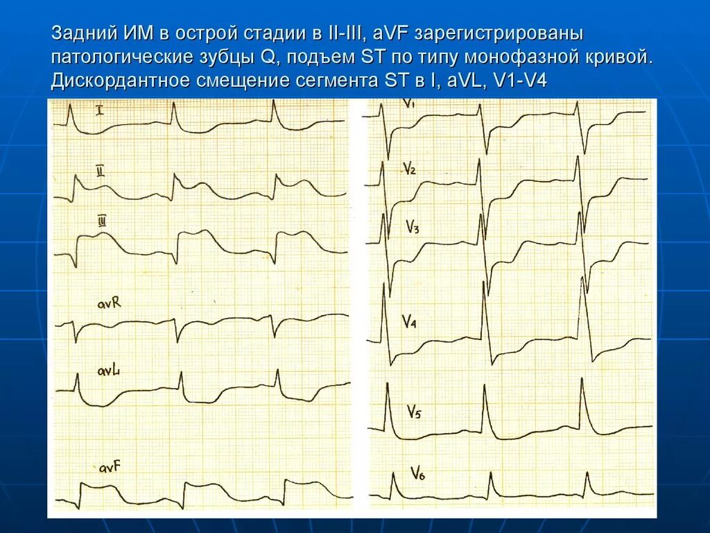 Экг подъем. Подъем сегмента St на ЭКГ v1-v6. Подъем сегмента St на ЭКГ В I, AVL v2-v5. ЭКГ подъем сегмента St в v2-v6. Подъём сегмента St на ЭКГ В v5-v6.