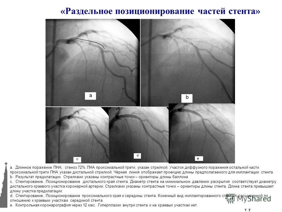 Стеноз проксимального отдела. Стеноз проксимального отдела