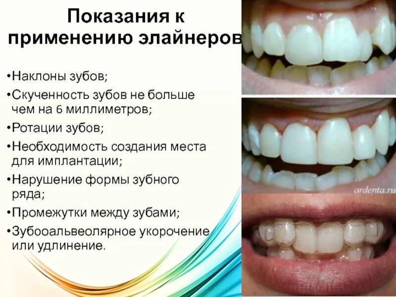 Сколько по времени делают зубы. Элайнеры скученность зубов. Скученность фронтальных зубов. Скученность нижних зубов. Элайнеры для зубов с резинками.