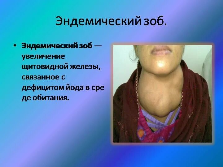 Недостаток йода заболевание. Эндемический зоб щитовидной железы. Йоддефицитные заболевания эндемический зоб. Эндемический зоб гипотиреоз. Гипотиреоз осложнения эндемический зоб.