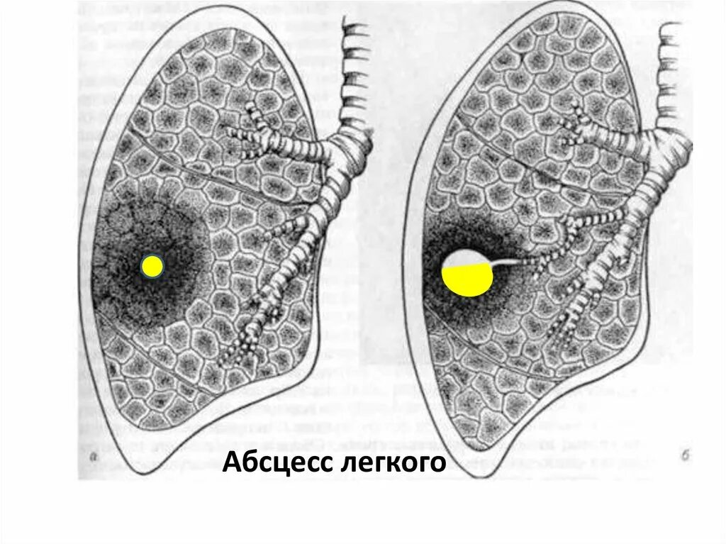 Гнойные абсцессы легких. Амёбиазный абсцесс лёгкого. Амебный абсцесс легких. Абсцесс легкого 2 стадия в средней доле схема. Бронхогенный абсцесс легкого.