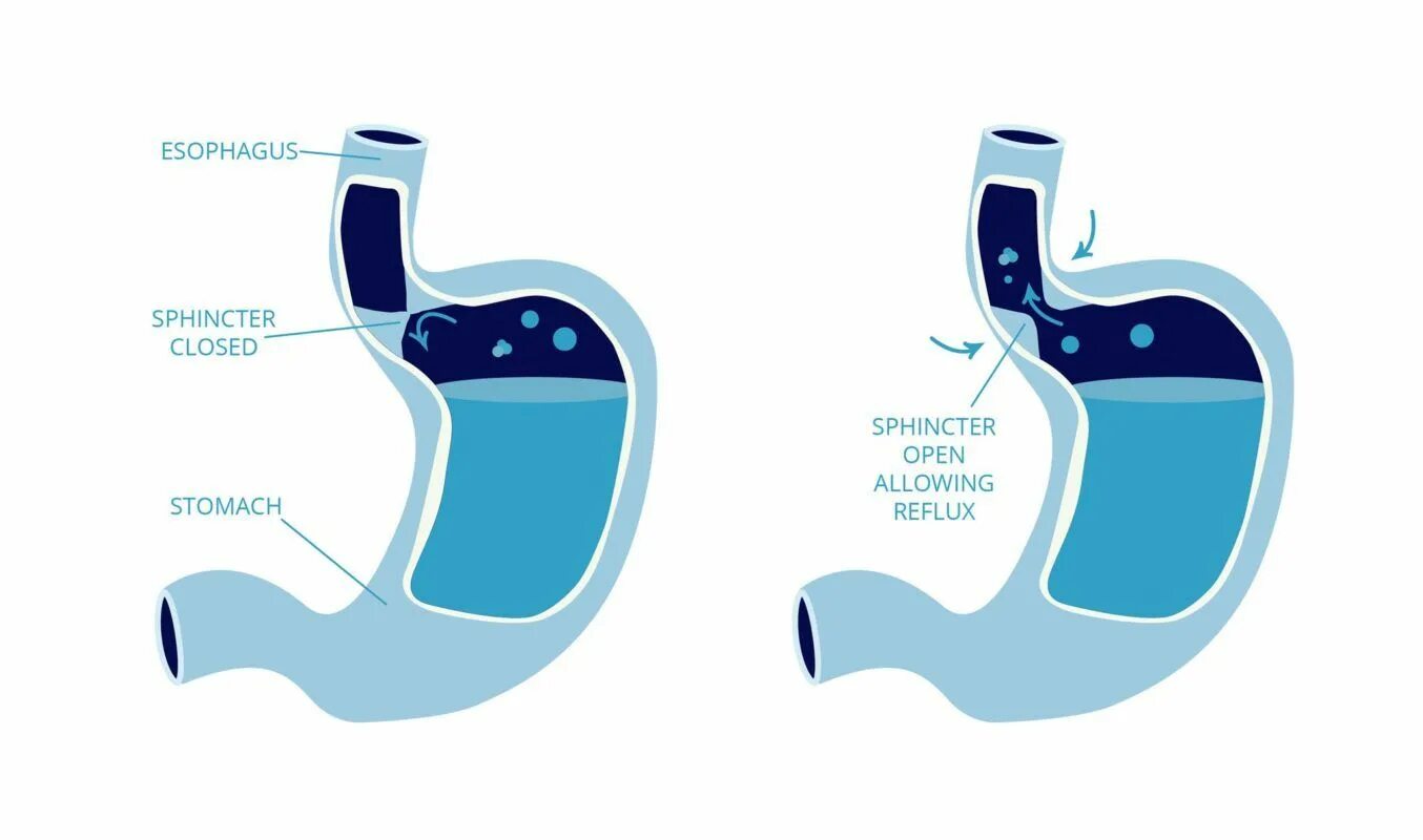 Изжога после воды. Рефлюкс при беременности симптомы. Гель против рефлюкса желудка. Изжога после резекции желудка.