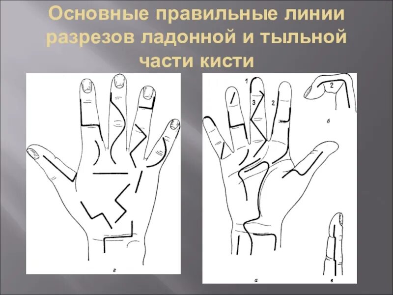 Разрезы на кисти. Разрезы на кисти. Разрезы на кисти. Гнойно воспалительные заболевания пальцев и кисти. Флегмоны срединного ложа кисти разрезы.