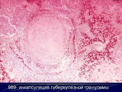 6 туберкулезная