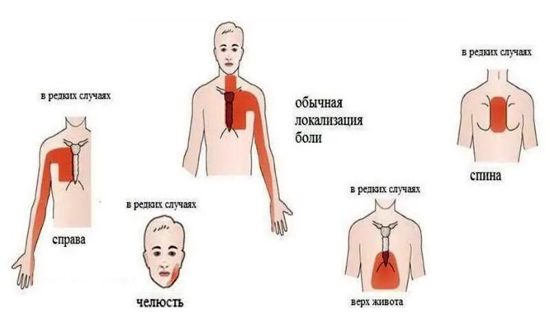 Боль в легком при пневмонии. Боль при стенокардии. Стенокардия симптомы. Симптомы при стенокардии.