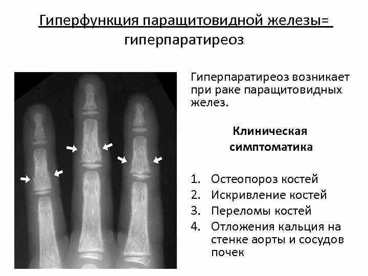 Гипофункция паращитовидных желез вызывает. При гиперфункции паращитовидных желез наблюдается. паращитовидная железа гипофункция и гиперфункция. паращитовидная железа паратгормон гиперфункция. при гипофункции паращитовидной железы наблюдается.