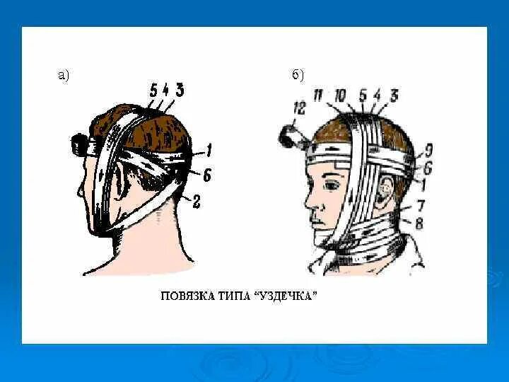 Повязка уздечка техника наложения. Техника уздечка. Техника уздечка. Технику наложения повязки «уздечка». Повязка уздечка десмургия.