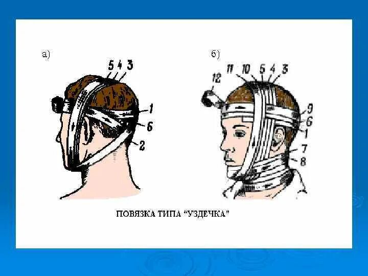 Бинтовая повязка уздечка. Наложение повязки на голову уздечка. Десмургия повязка уздечка. Повязка уздечка техника наложения. Повязка уздечка накладывается
