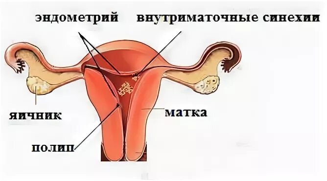 Синехии эндометрия на УЗИ. Маточное бесплодие