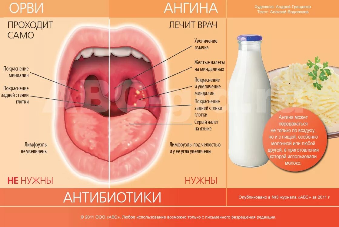 Насморк и больное горло без температуры. Вирусная и бактериальная ангина.