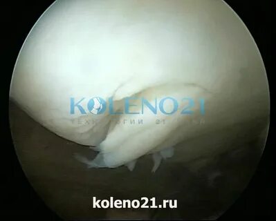 Повреждения хряща коленного сустава тест
