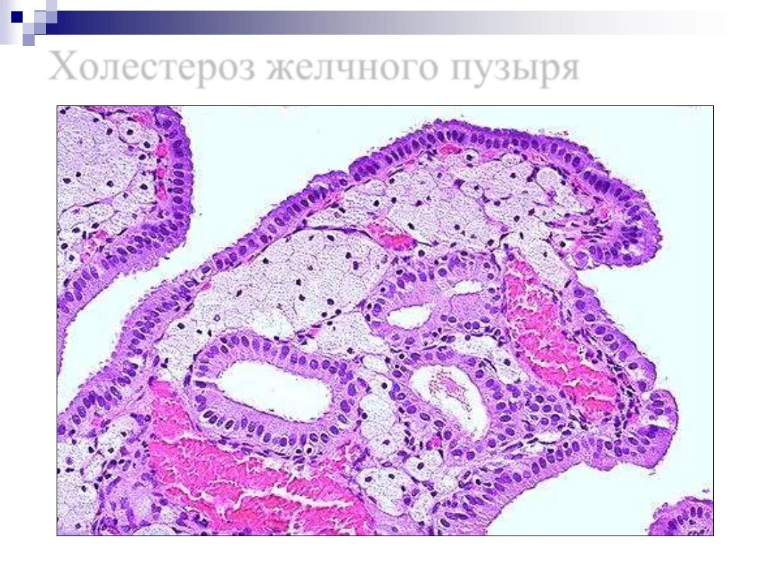 Холестероз желчного пузыря гистология. Холестероз желчного пузыря микропрепарат. Железы желчного пузыря гистология. Холестероз гистология.