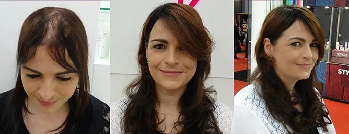 Система волос. Система замещения волос. система волос для женщин. система замещения волос для женщин. система замещения волос до и после.