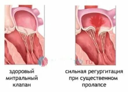 Пролапс задней стенки