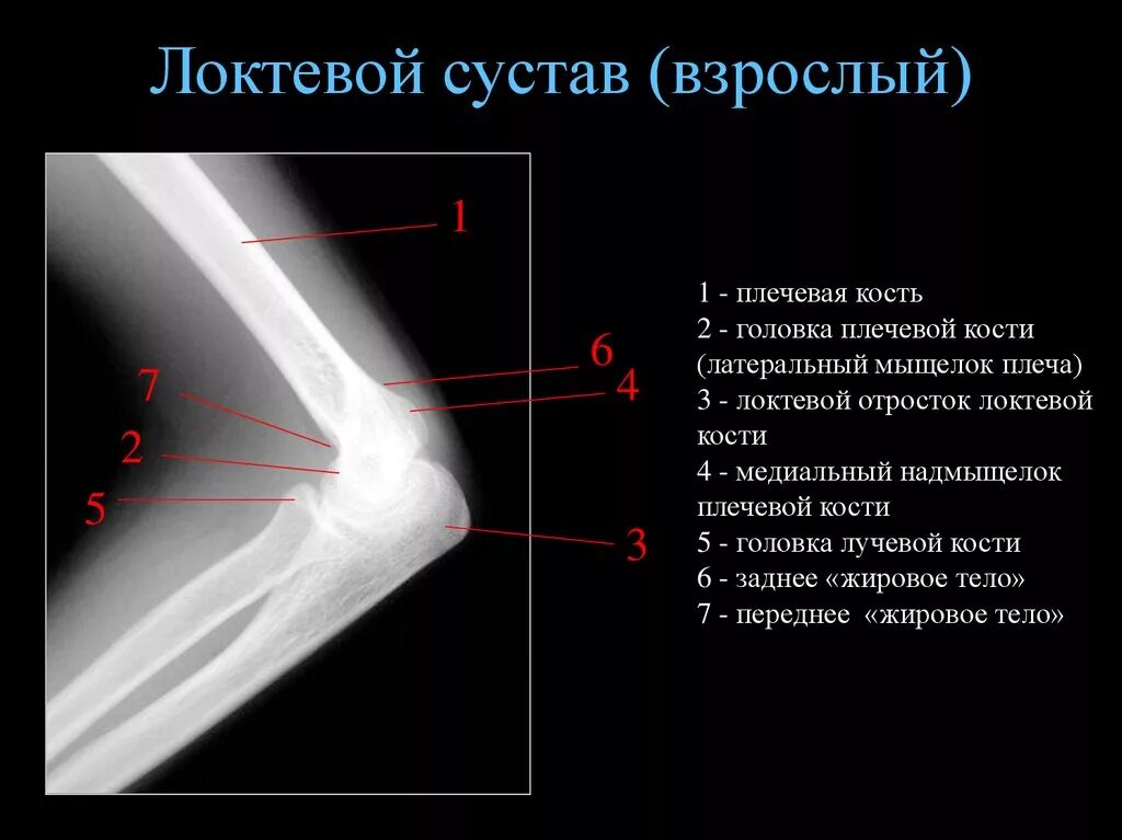 Локтевого мыщелка. Анатомия костей плечевого сустава рентген. Головка мыщелка локтевой кости. Плечевая кость рентген локтевого сустава. Отрыв венечного отростка локтевой кости.