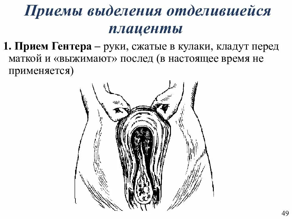 Выделение последа. Способы выделения последа (абуладзе, креде-лазаревича, гентера). наружные методы выделения последа гентера. способы наружного выделения последа. метод отделения последа по абуладзе.