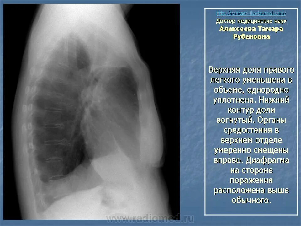 Увеличение внутригрудных лимфатических узлов. Внутригрудные лимфоузлы на кт. Туберкулез внутригрудных лимфоузлов. Лимфаденопатия внутригрудных узлов.