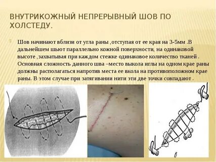 Сколько ходят со швами