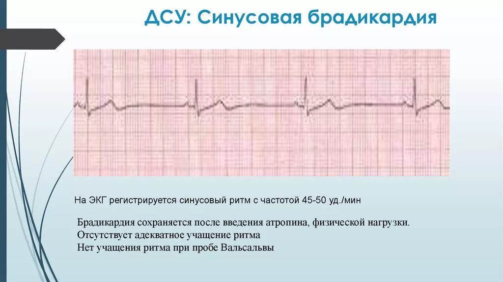 Дисфункция синусового узла что это. ЭКГ при синусовой брадикардии. Синусовая брадикардия ЭКГ признаки. Синусовая брадикардия на ЭКГ. Синусовая брадикардия ЭКГ проявления.