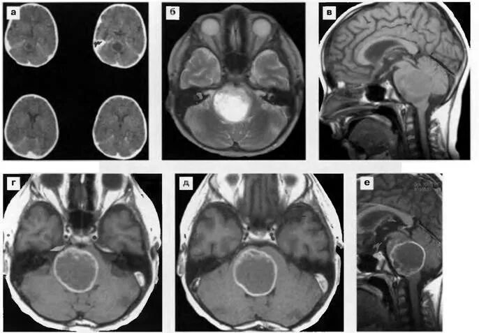 Глиома мозгового ствола. Глиома ствола головного мозга мрт. Диффузная глиома ствола головного мозга. Опухоль ствола головного мозга мрт. Глиома головного ствола