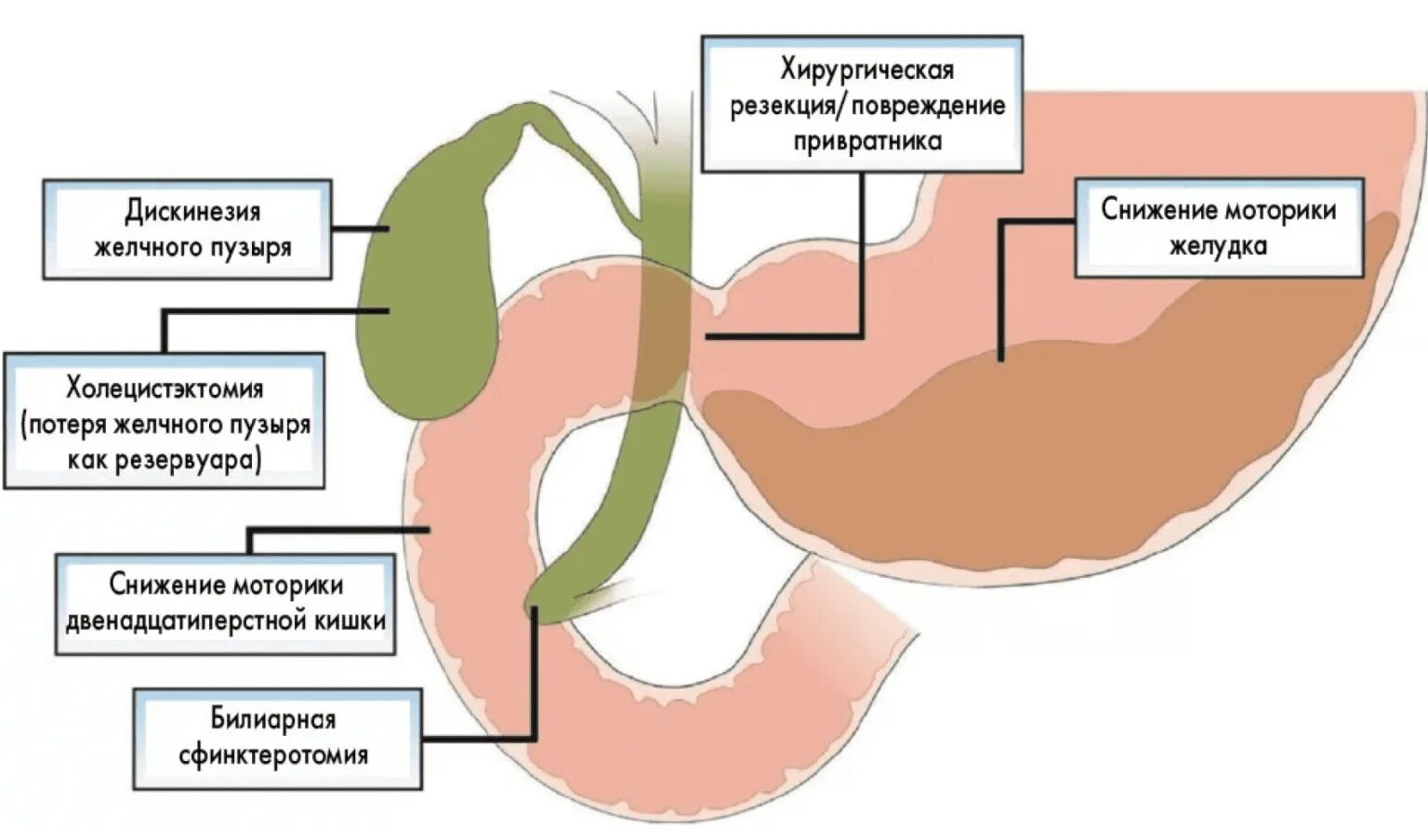 Рефлюкс 12 перстной кишки. Дуоденит гастральный рефлюкс. ДГР дуоденально-гастральный рефлюкс что это. Дуоденальный гастрит рефлюкс. Атрофический рефлюкс