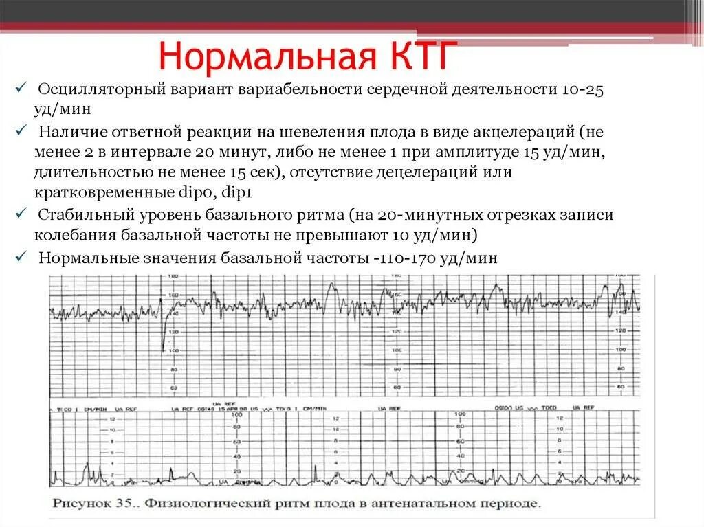 Исследование сердцебиения плода. КТГ мониторинг при беременности. Нормальная диаграмма КТГ. Норма ЧСС плода на КТГ. Нормальные показатели КТГ плода.