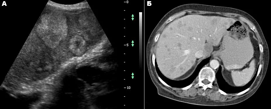 Гиперваскулярные метастазы печени кт. Гиповаскулярные метастазы печени кт. Гепатоцеллюлярная аденома печени УЗИ. Кт гепатобластома печени. Очаговые гемангиомы печени