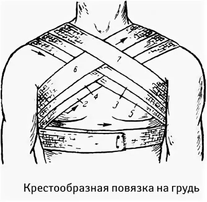 Повязка на молочные железы алгоритм. Наложение восьмиобразной повязки на грудную клетку. Наложение крестообразной повязки на грудную клетку. Десмургия восьмиобразная повязка. Перевязка грудной клетки алгоритм.