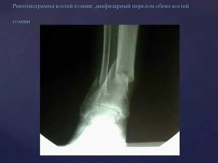 Голень перелом нижней