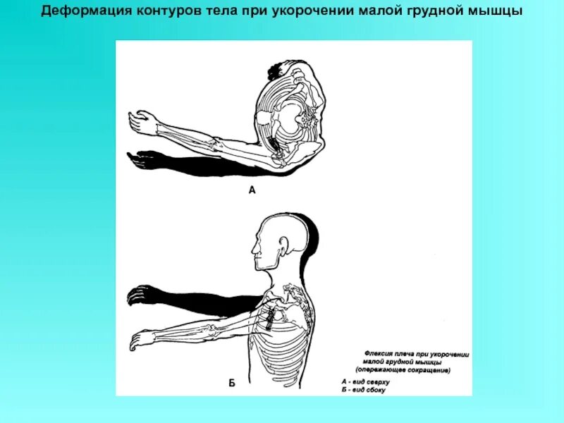 Деформация мышц. Укорочение малой грудной мышцы. деформация контуров тела. деформация контуров тела при укорочении. укороченные грудные мышцы.