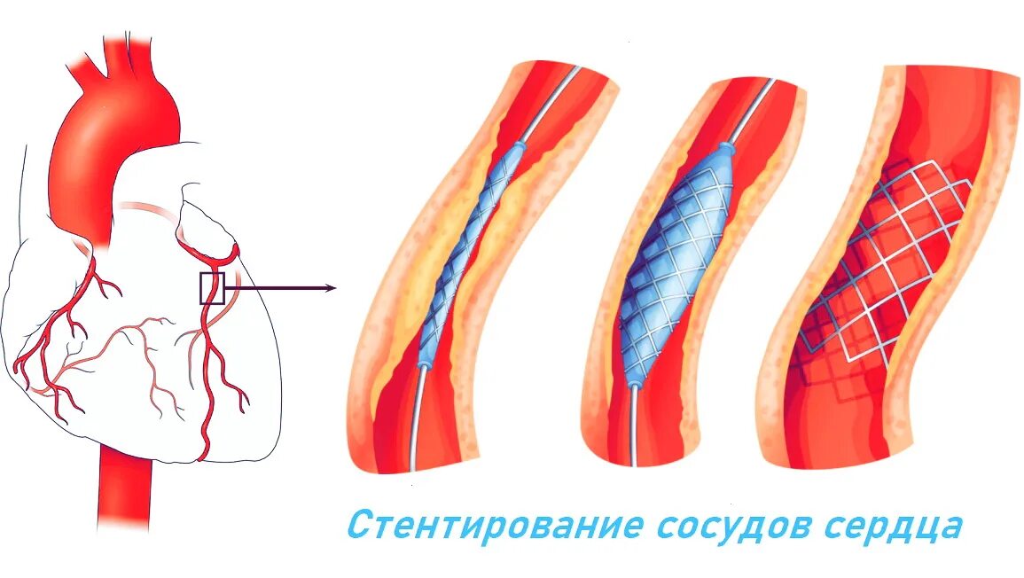 Операция через сосуды. Коронарное шунтирование сосудов сердца. Стентирование коронарных сосудов. Операция стентирование сосудов сердца. Шунтирование сосудов сердца стент.