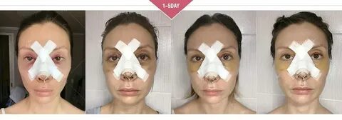 Текст песни ринопластика kai