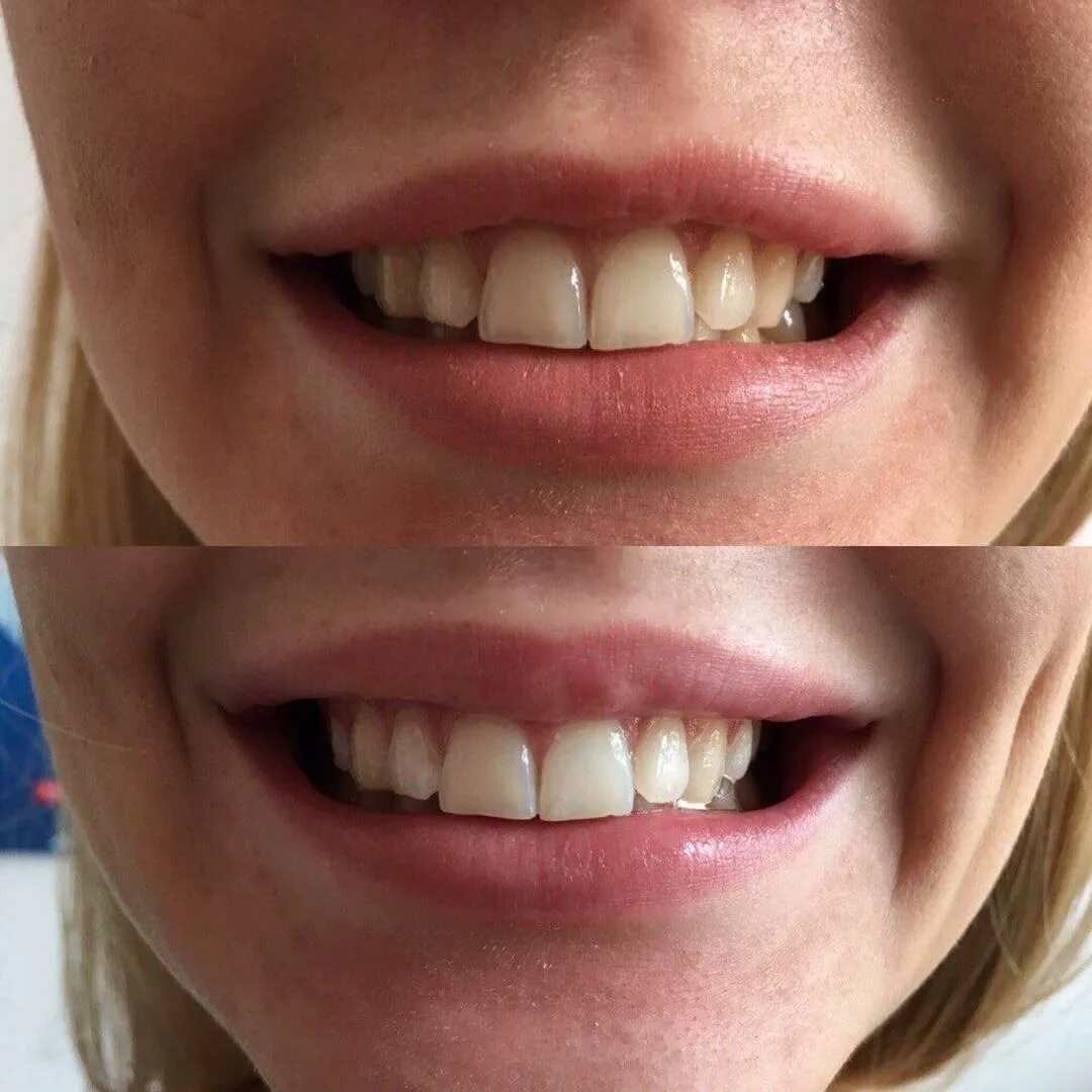 Отбеливание зубов white smile. Студия по отбеливанию зубов. Смайлами отбеливание. Косметическое отбеливание зубов white smile. Отбеливание зубов улыбка.