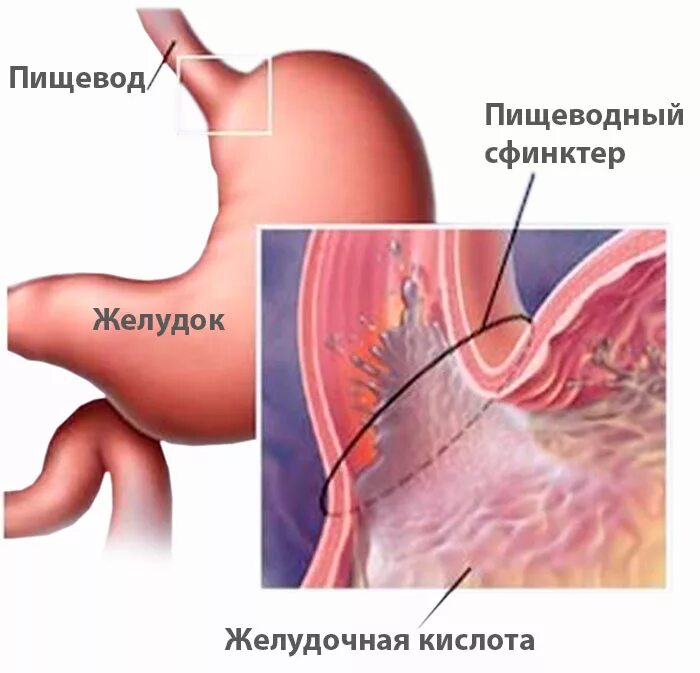 Ленивый желудок симптомы. Диспепсия желудка. Несварение желудка. Желудочная и кишечная диспепсия. Неязвенная диспепсия.