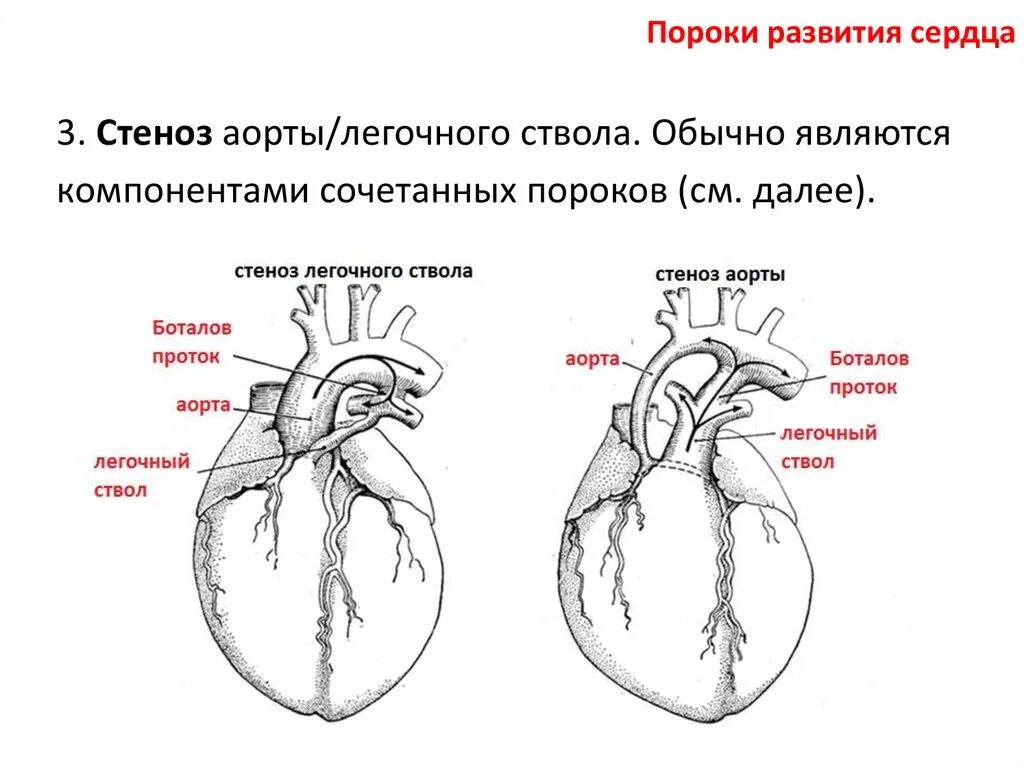Приобретенные пороки сердца схема. Пороки развития сердца анатомия.