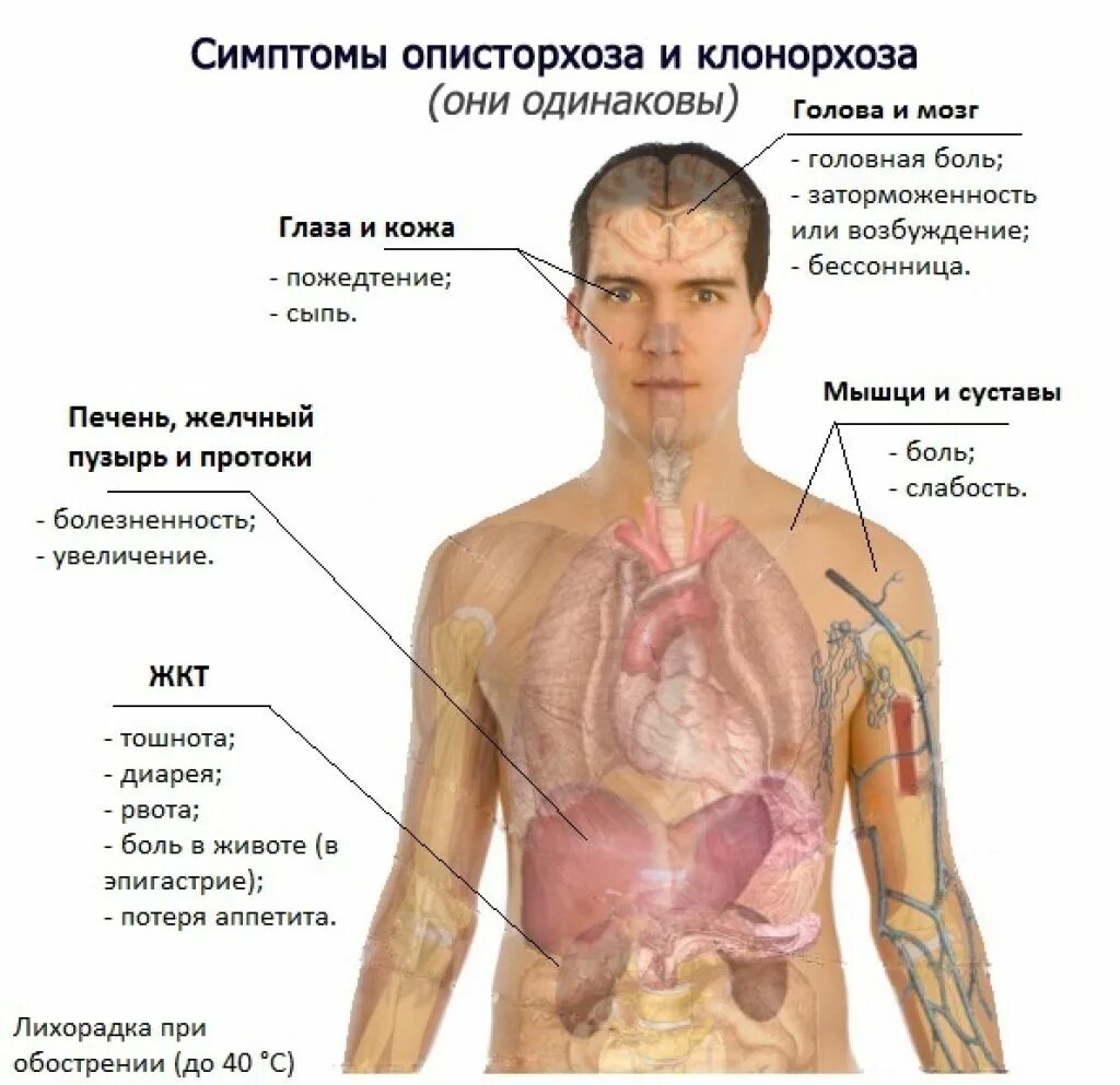 Симптомы болезни у взрослых. Клинические проявления описторхоза. клинические симптомы описторхоза. описторхоз клинические синдромы. описторхоз органы поражения.