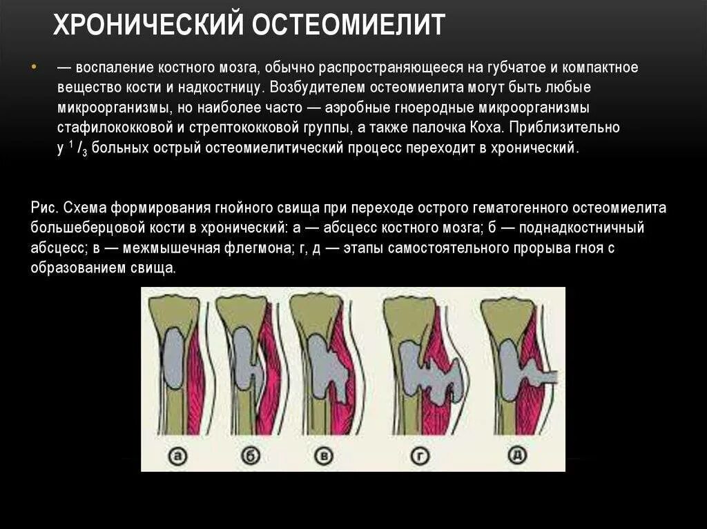 Костный как проверить