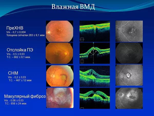 Лечение дегенерации макулы. Возрастная макулярная дегенерация сетчатки глаза. Возрастная макулярная дегенерация формы. Макулярная дегенерация сухая форма.
