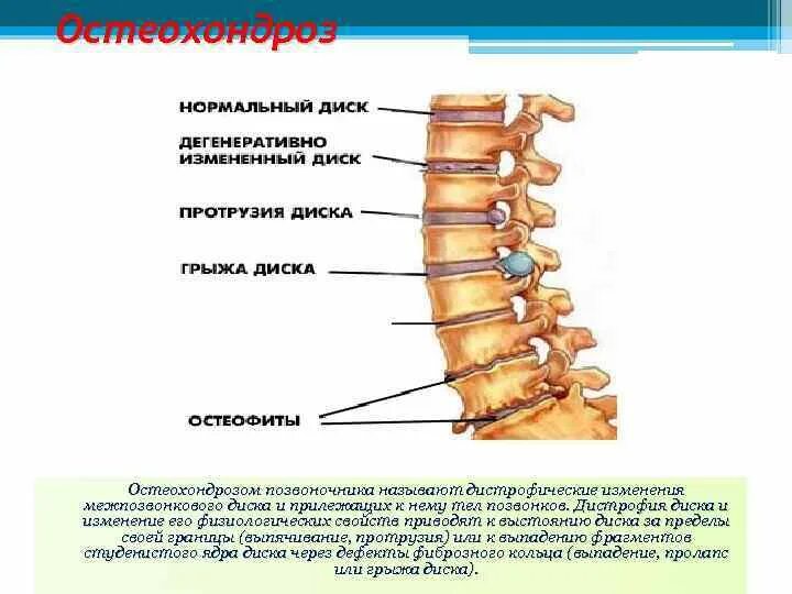 Остеохондроз шейного отдела протрузии. Позвоночник - протрузия и грыжа диска. Позвоночник человека протрузия диска. Остеохондроз шейного отдела грыжи дисков. Грыжи позвоночника в поясничном отделе схема.