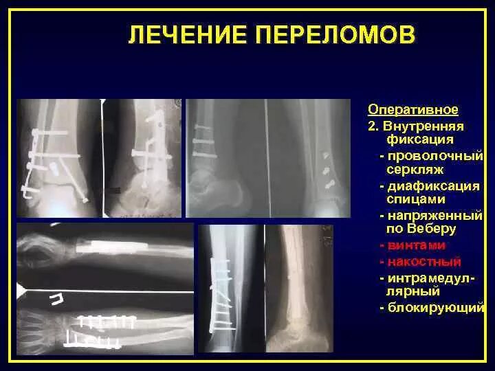 Оперативное решение переломов. Оперативное лечение переломов. Оперативное лечение переломов лодыжек. Оперативное лечение перелома костей