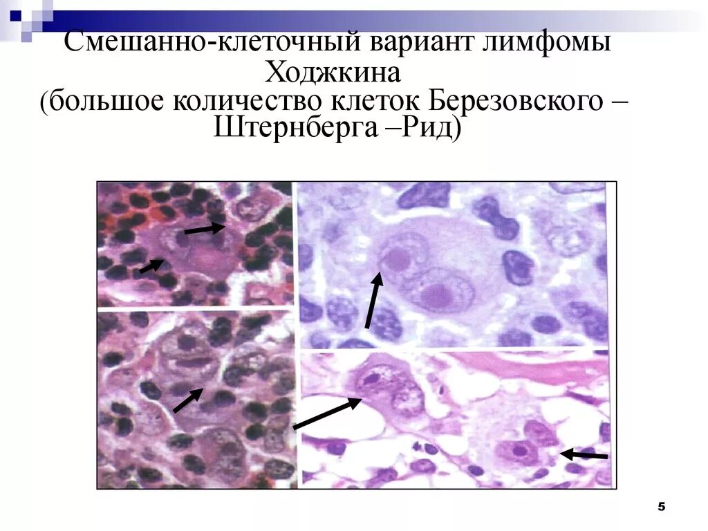 Рид штернберга. Клетки Рид-Березовского-Штернберга. Клетки Березовского-Штернберга гистология. Клетки Рида Березовского Штернберга. Морфология клеток Рид-Березовского-Штернберга.