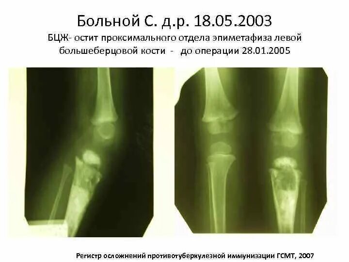 Остит большеберцовой БЦЖ большеберцовой кости. Остеомиелит большеберцовой кости рентген. Хронический остеомиелит большеберцовой кости рентген.