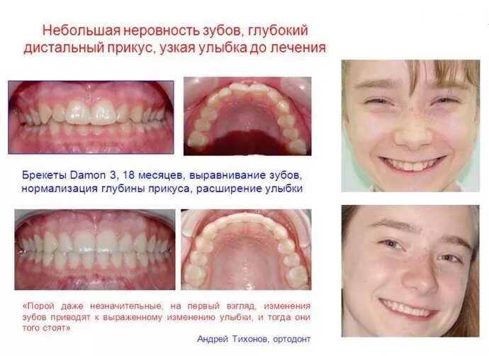 ГЛУБОКАЯ РЕЗЦОВАЯ ОККЛЮЗИЯ В норме верхние