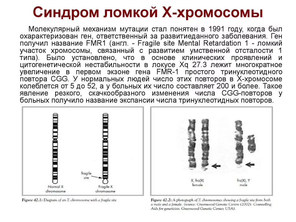 Вторая х хромосома. Х-хромосома человека. Синдром ломкой х-хромосомы. Кариотип стндрома ломкости х хромосомы.