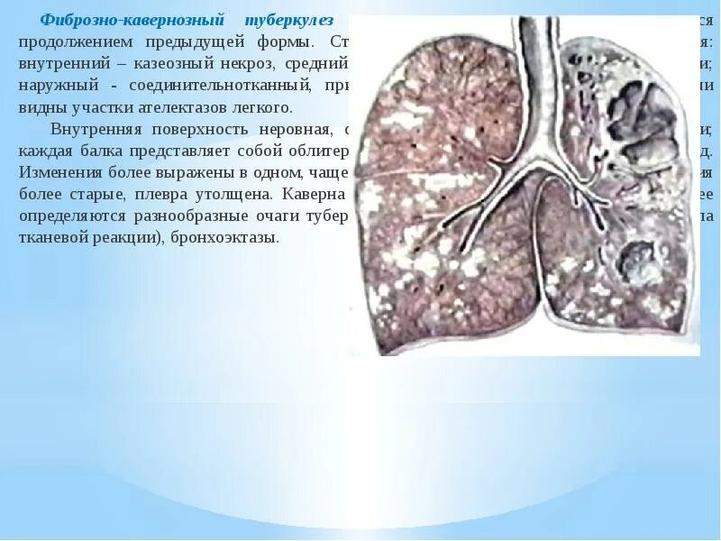 Каверна при туберкулезе. Фиброзно-кавернозный туберкулез каверны. Казеозный туберкулез легких. Кавернозный туберкулез легких кт. Кавернозный туберкулез полость.