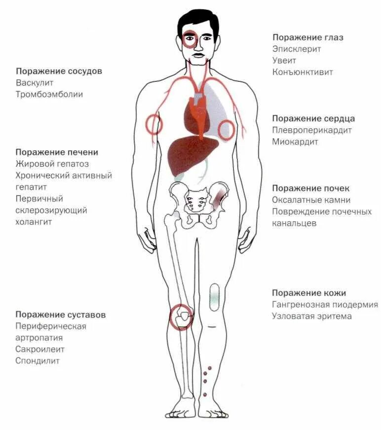 Болезнь крона лечение у взрослых кишечника. Внекишечные проявления болезни крона. Внекишечные проявления болезни крона таблица. Кишечные осложнения болезни крона. Клинические признаки болезни крона.