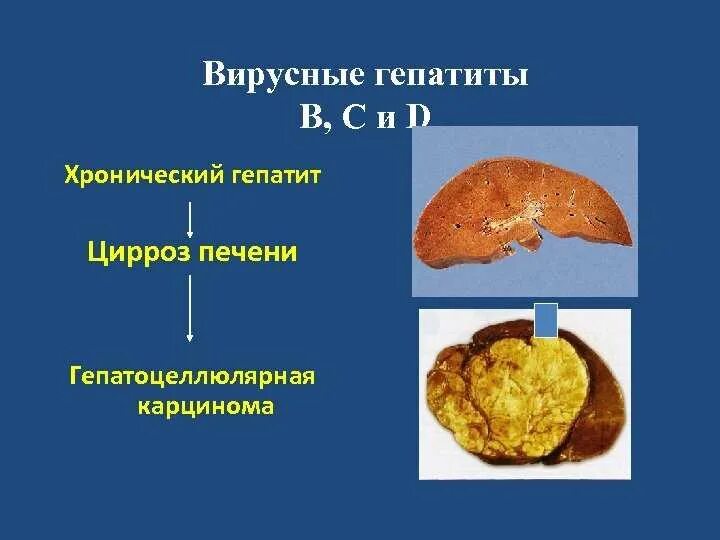 Гепатоцеллюлярный рак печени фото Mts кт