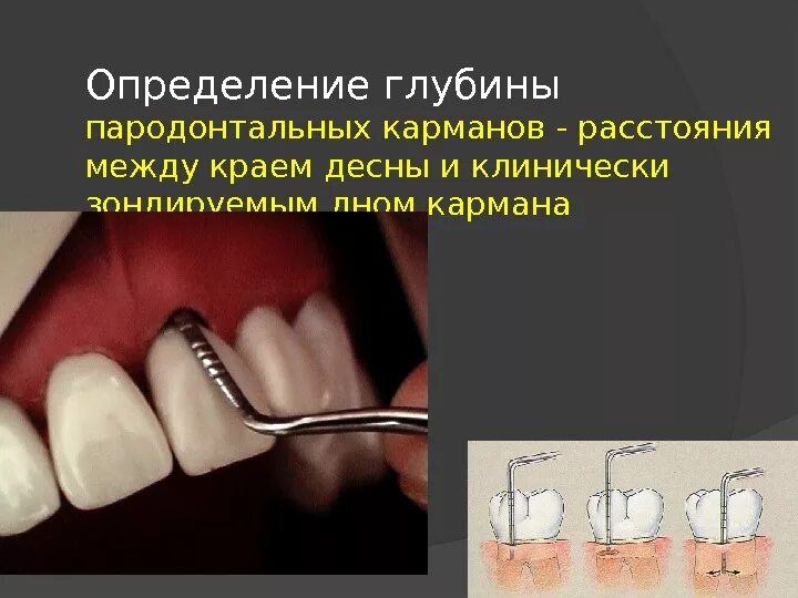 Карманы над зубами