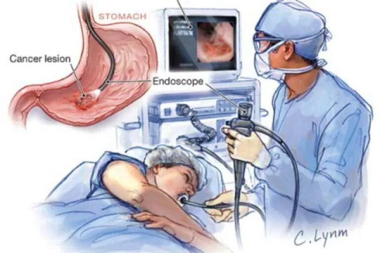 Эзофагогастродуоденоскопия пищевода. Эндоскопическое исследование. Эндоскопическое исследование желудка. Биопсия язвы