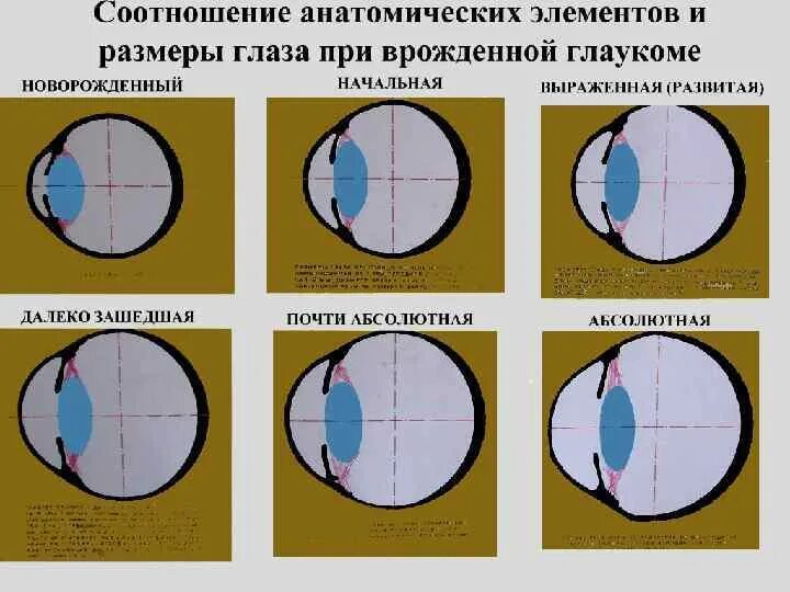 Что нельзя делать при глаукоме. Глаукома начальная стадия. Стадии первичной глаукомы. Классификация открытоугольной глаукомы.